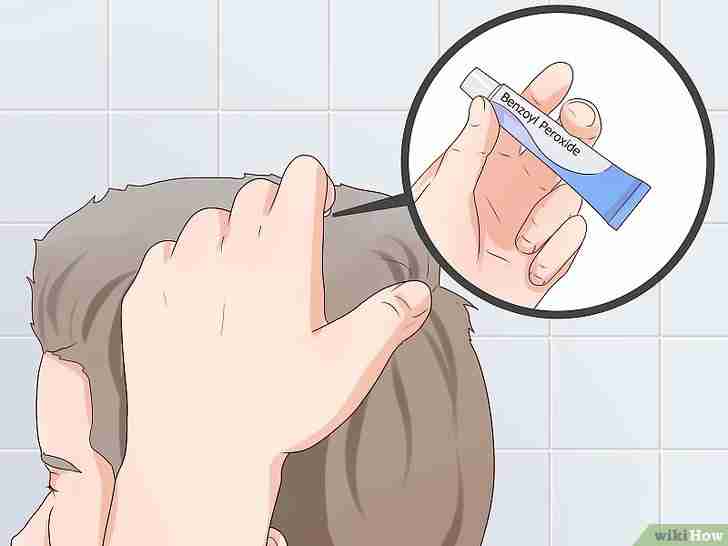 Imagen titulada Treat Scalp Pimples Step 1
