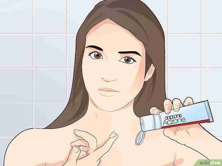 Imagen titulada Treat Scalp Pimples Step 6